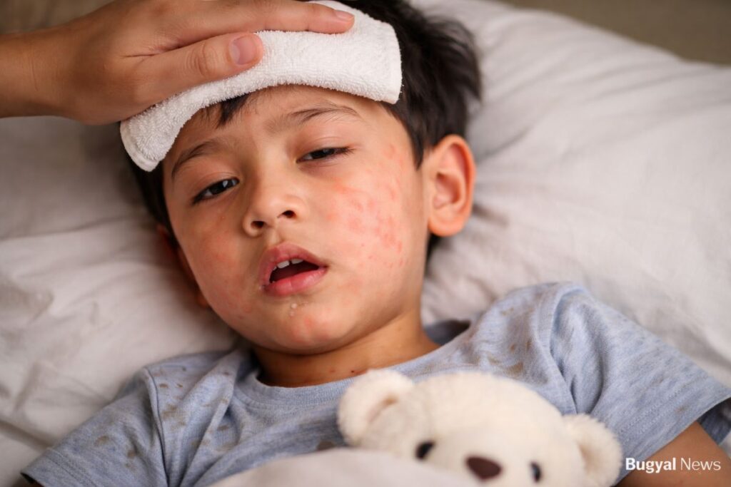 Measles Outbreak Bangladesh